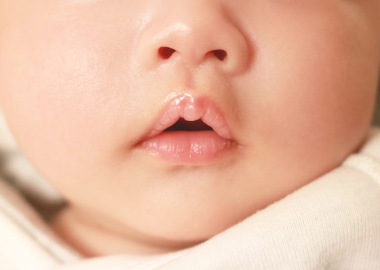 新生児 唇 の 皮